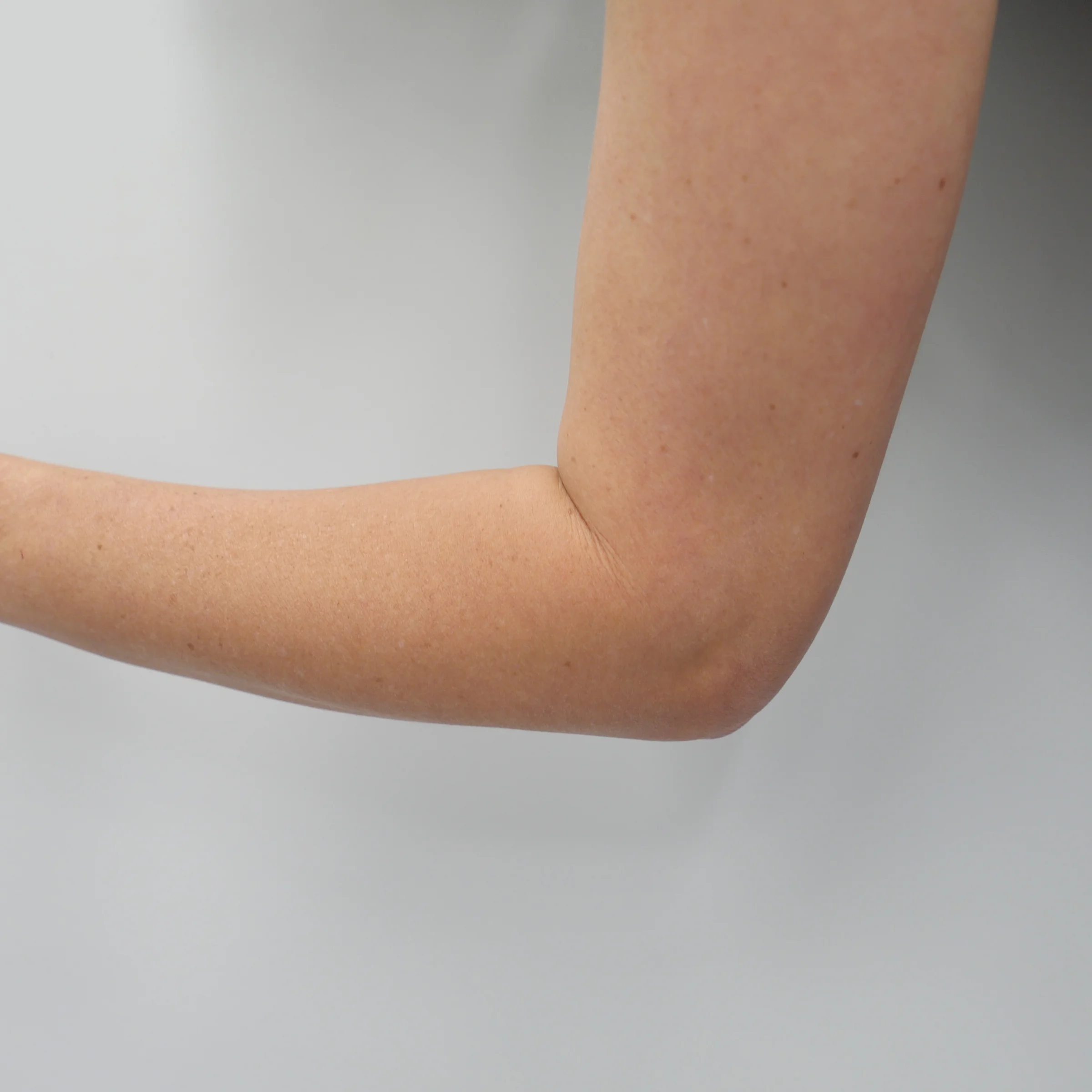 Elbow surgery at CQ Hand + Upper Limb, Rockhampton