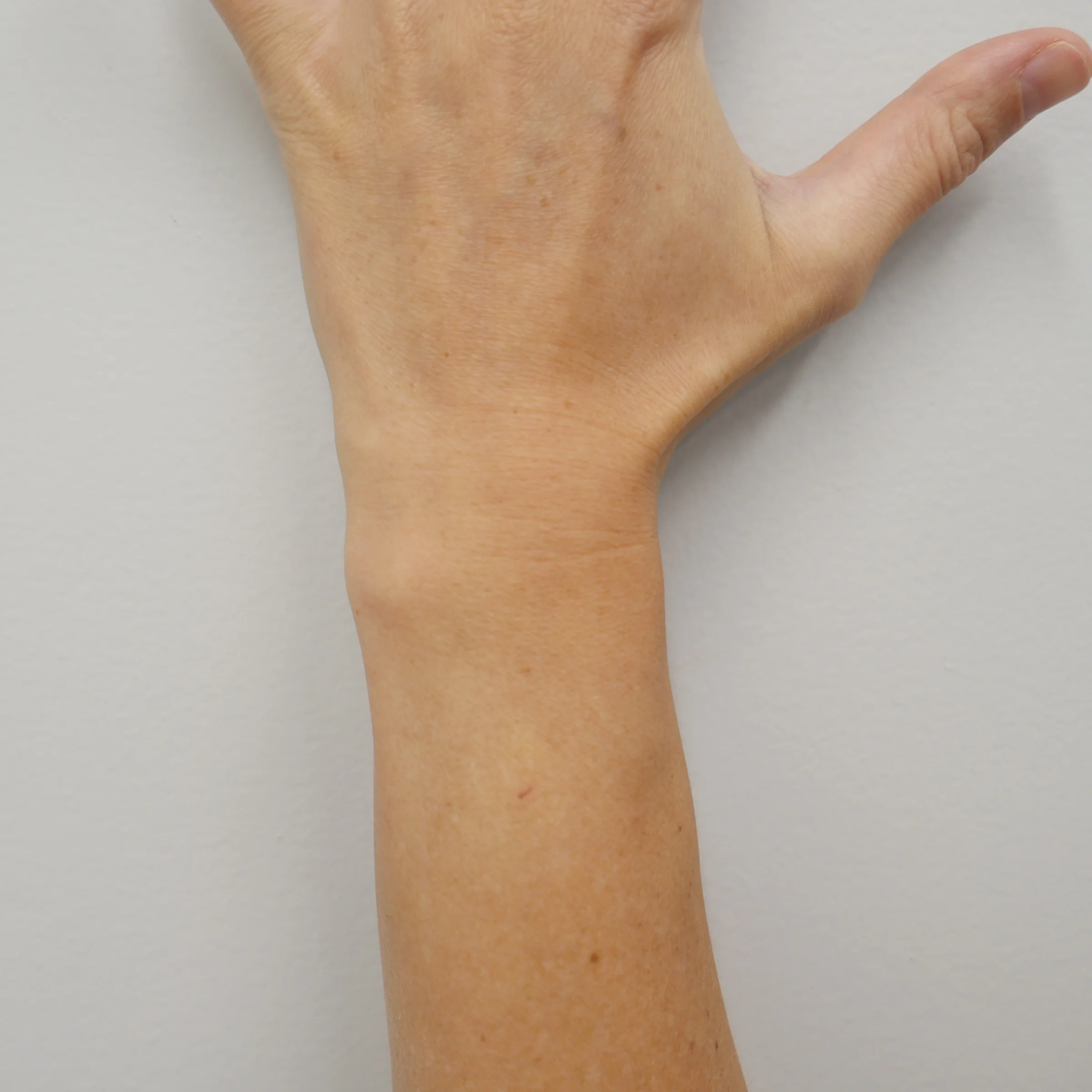 Wrist surgery at CQ Hand + Upper Limb, Rockhampton